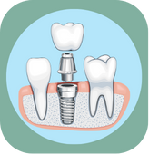 Dental Implants Aelite